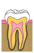root canal